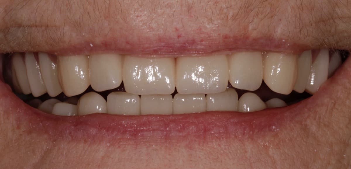 Implant Retained Case 2